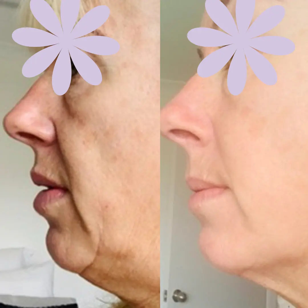 Advanced HIFU & EMS Skin Tightening Device | Lift, Firm & Sculpt Your Face